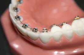 What are Invisible Lingual Braces?