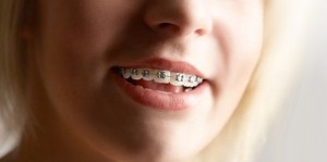 Girl Braces Dr. Gordon C. Honig, DMD Newark Middletown DE