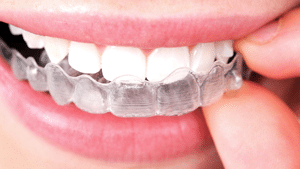 Different Types of Braces and their Costs - Dent Ally